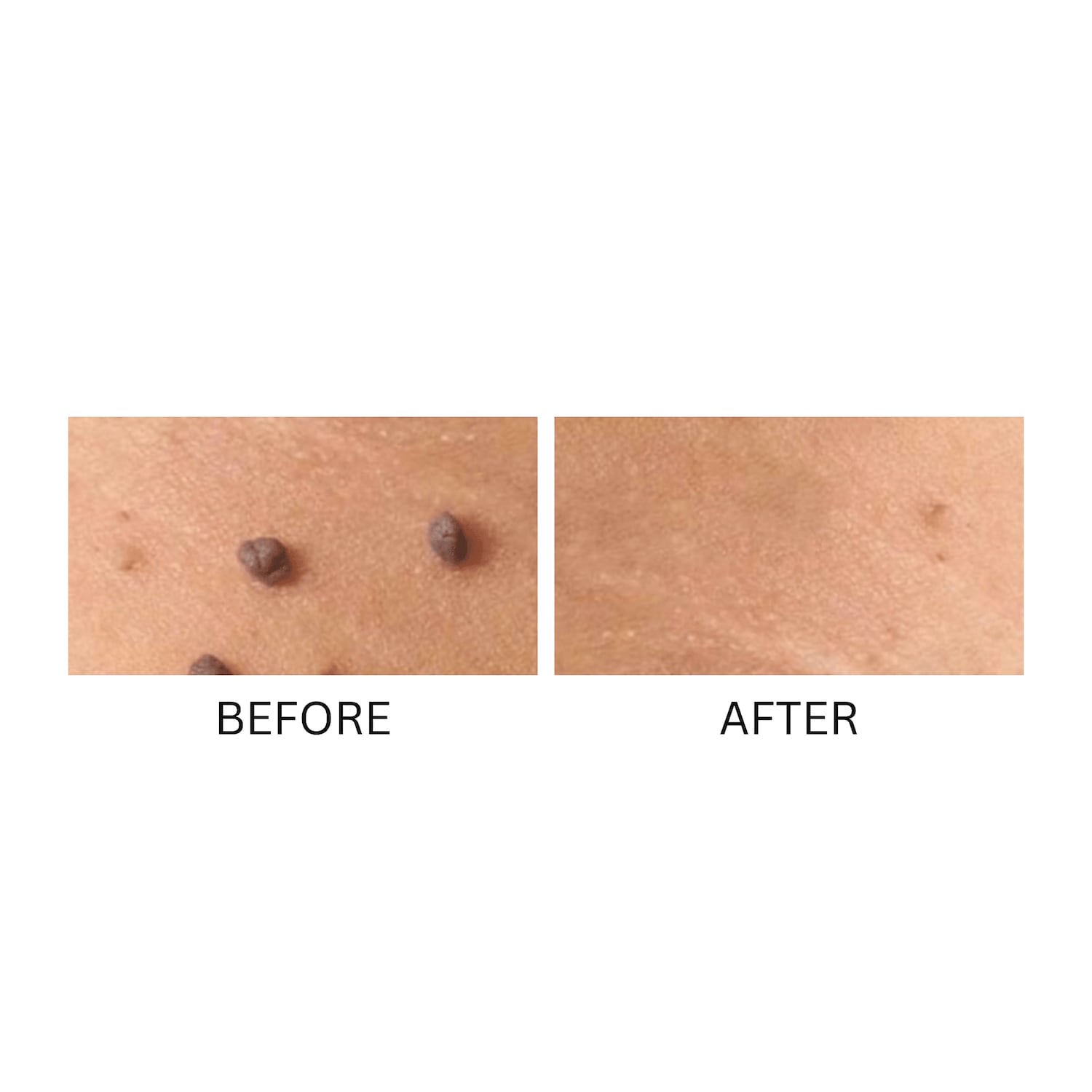 Skin Perfect Skin Tag & Wart Remover Carol Wright
