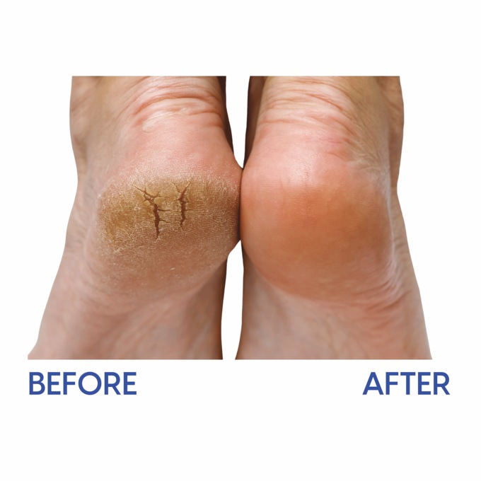 Relief Now Diabetic Dry Skin Relief Foot Cream , , large
